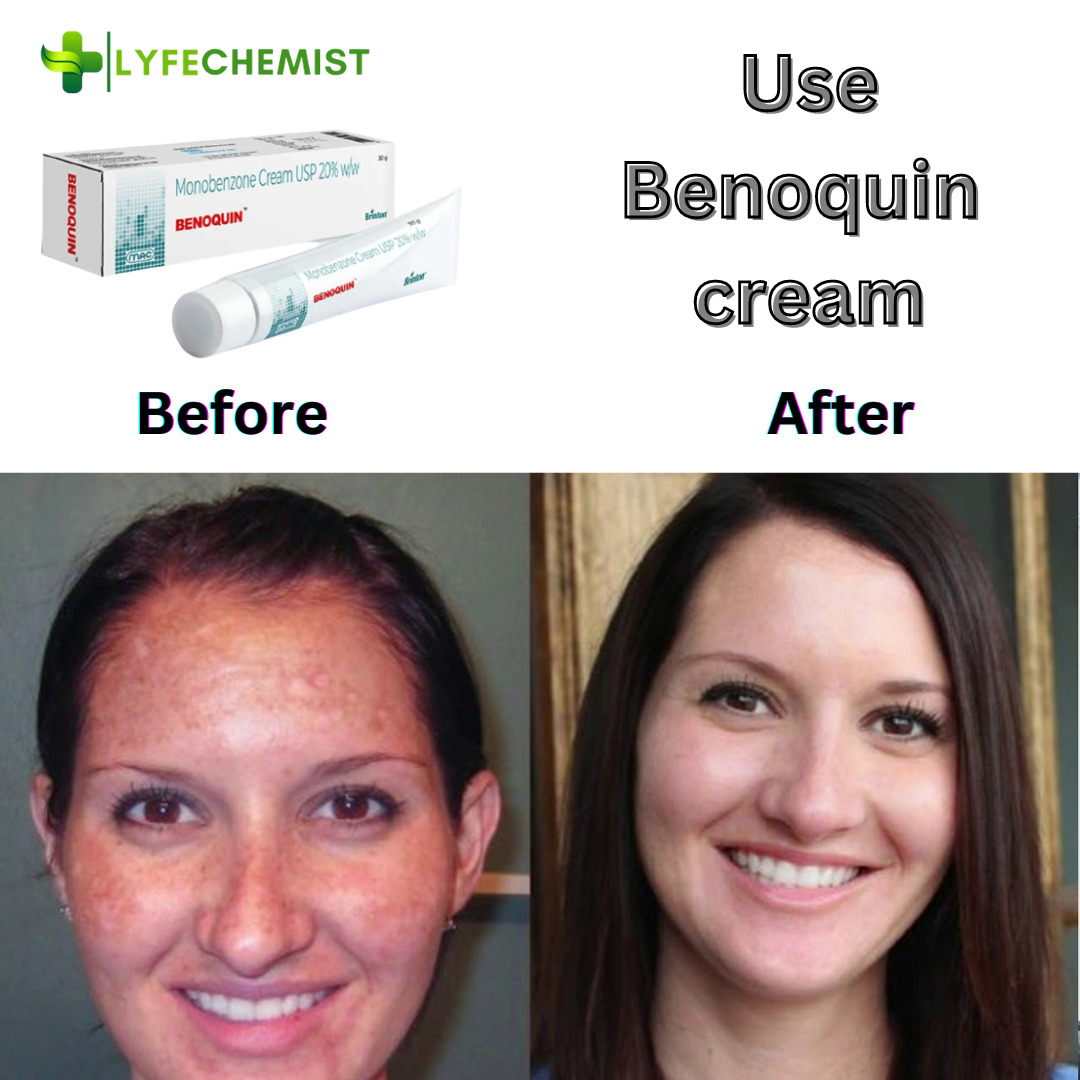 before and after use of benoquin cream