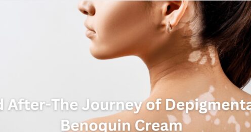 Depigmentation with Benoquin Cream