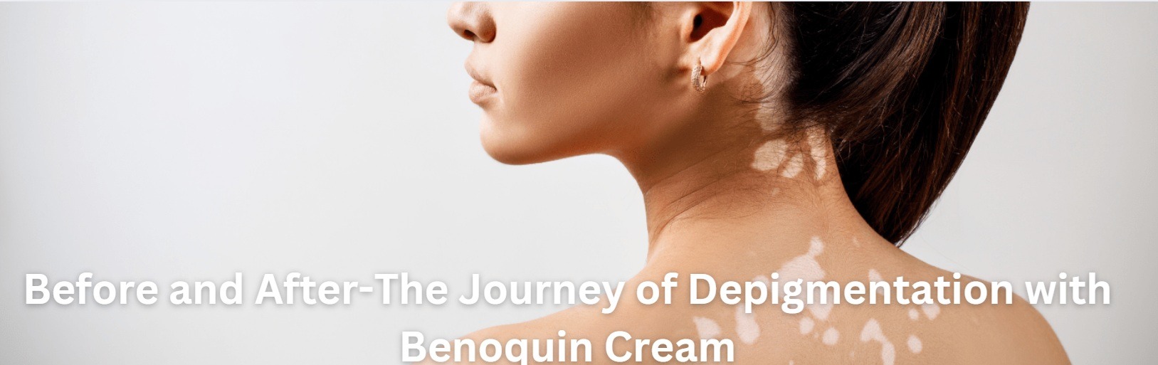 Depigmentation with Benoquin Cream